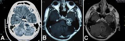 Surgery After Surgery for Vestibular Schwannoma: A Case Series